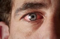 How to deal with allergic conjunctivitis